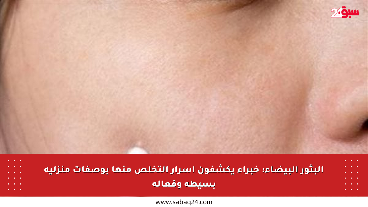 البثور البيضاء: خبراء يكشفون أسرار التخلص منها بوصفات منزلية بسيطة وفعالة